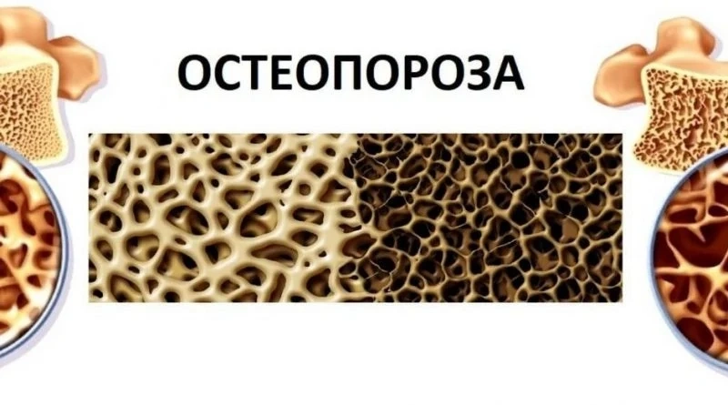 Проверете риска си от Остеопороза!  
