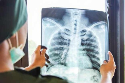 Преглеждат безплатно за туберкулоза в Пазарджик в периода 14–18 септември